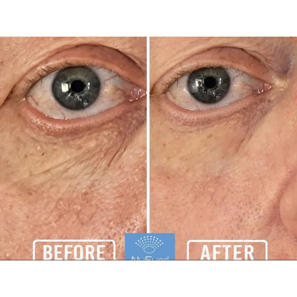 NuEyes results pic